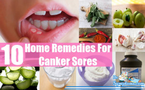 Natural Remedies For Canker Sores Cure Dr Symptoms