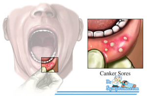 canker sore