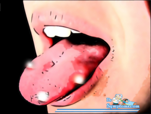 canker sore at tounge