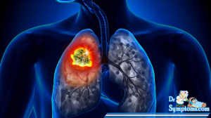 Lung Cancer