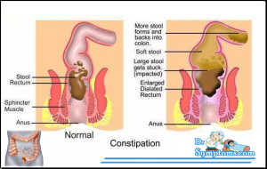 Causes of constipation