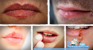 How To Get Rid Of Cold Sores